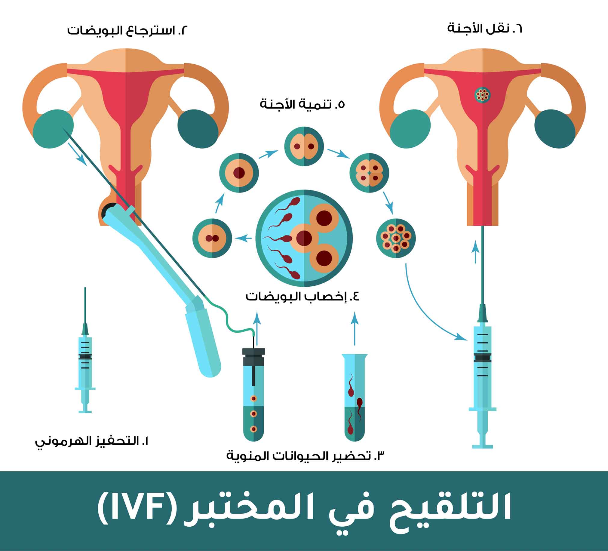 عملية التلقيح في المختبر (IVF)