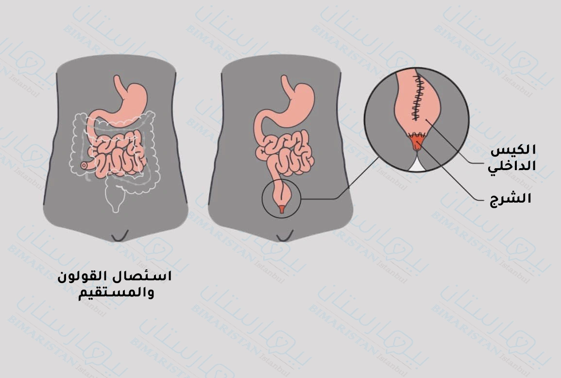 The process of removing the colon and rectum permanently, after which an anastomosis is made between the end of the small intestine and the anus, and this process is used in the treatment of ulcerative colitis.