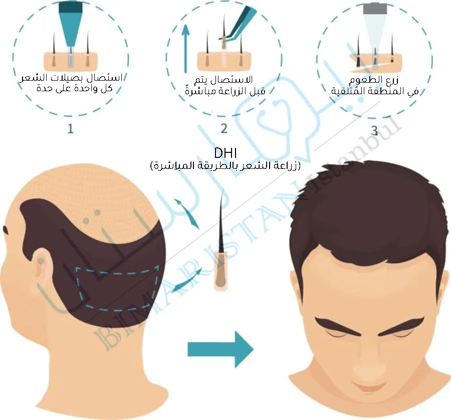 Direct hair transplant steps in Turkey