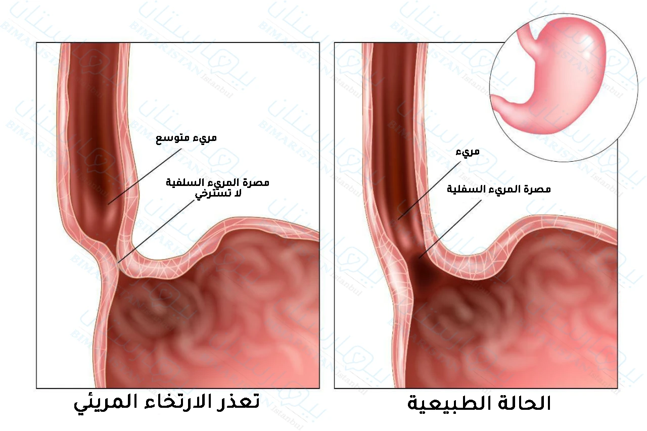 This image shows a comparison between the normal state and the case of achalasia.
