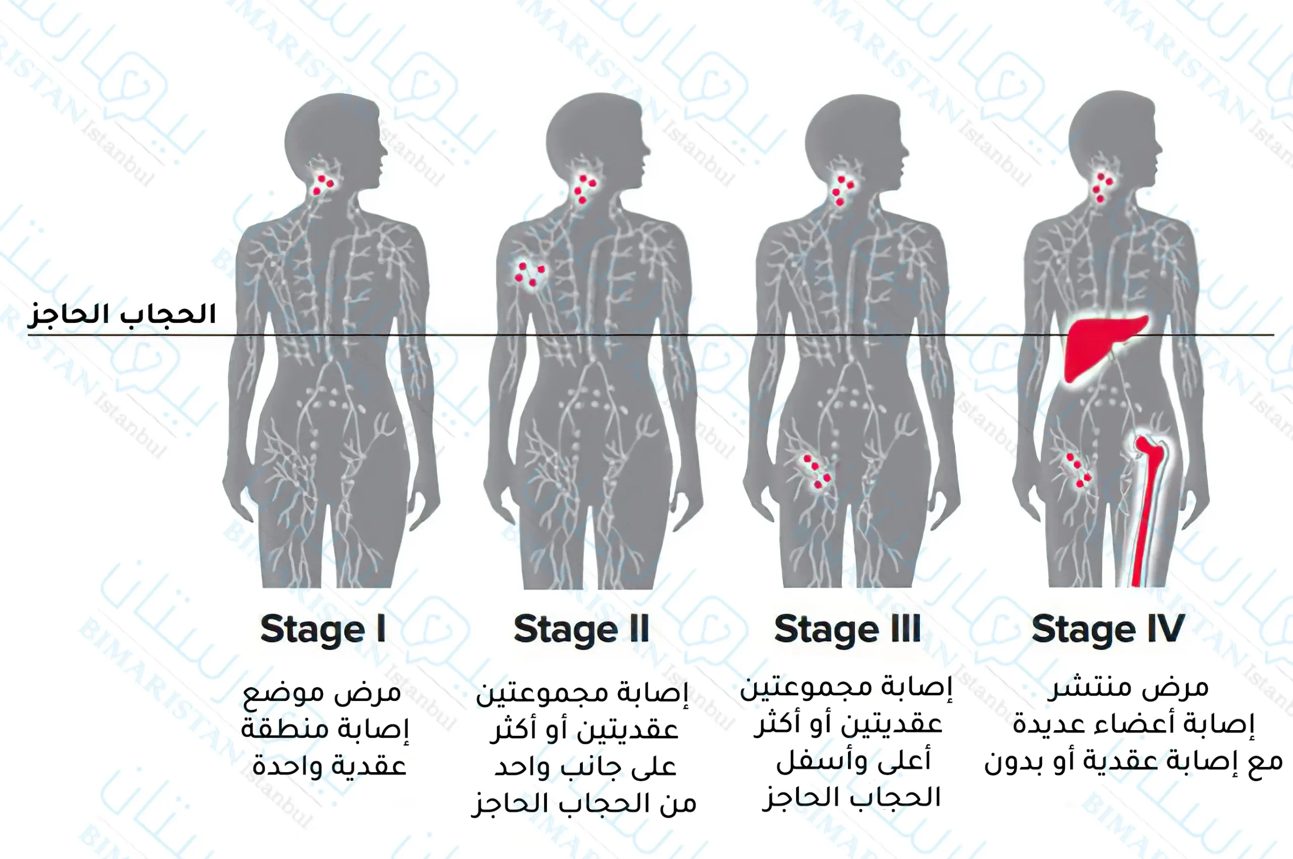 التصنيف المرحلي للمفوما لا هودجكن (تصنيف لوغانو)