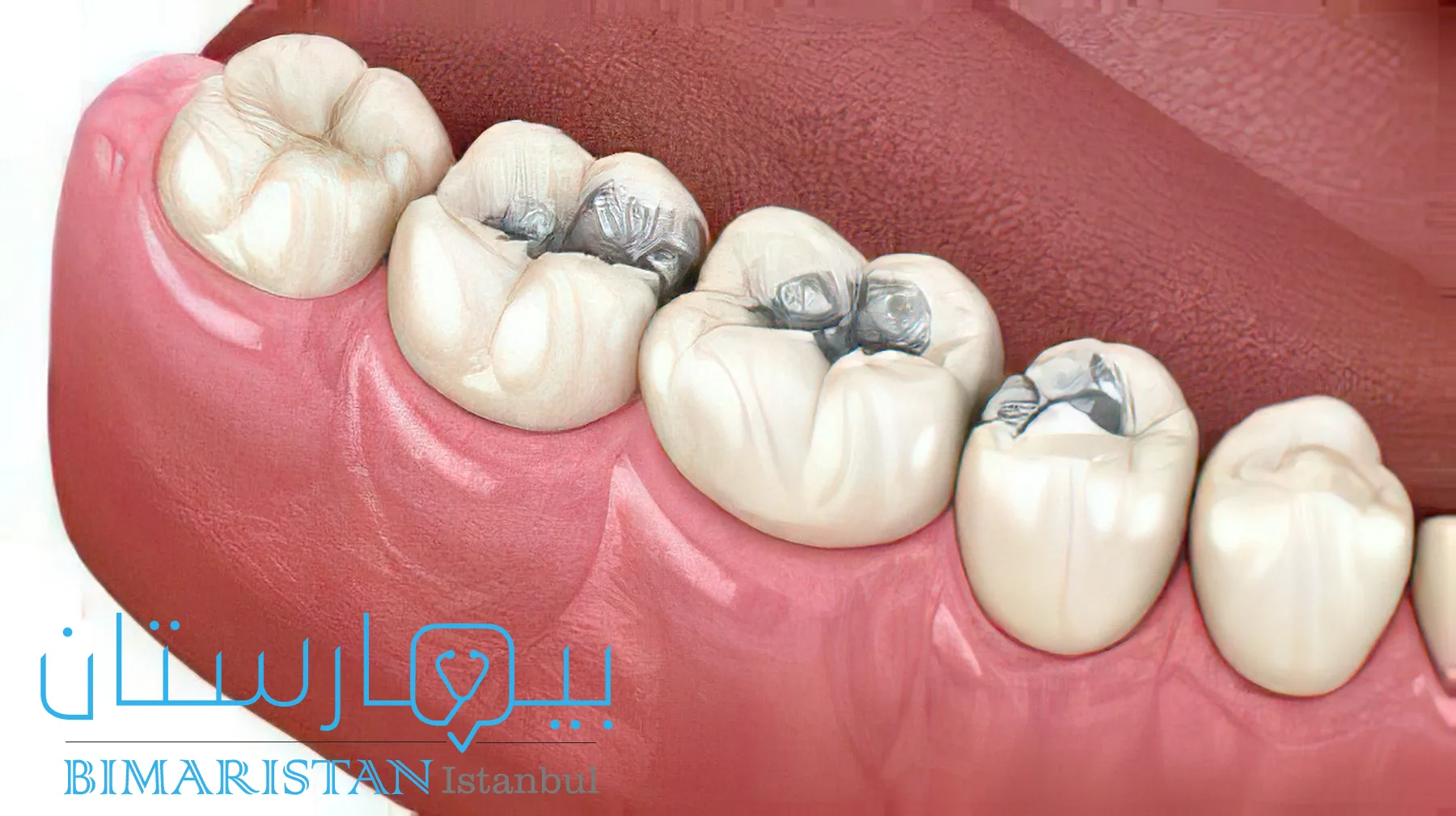 علاج تسوس الأسنان باستخدام الحشوات في اسطنبول