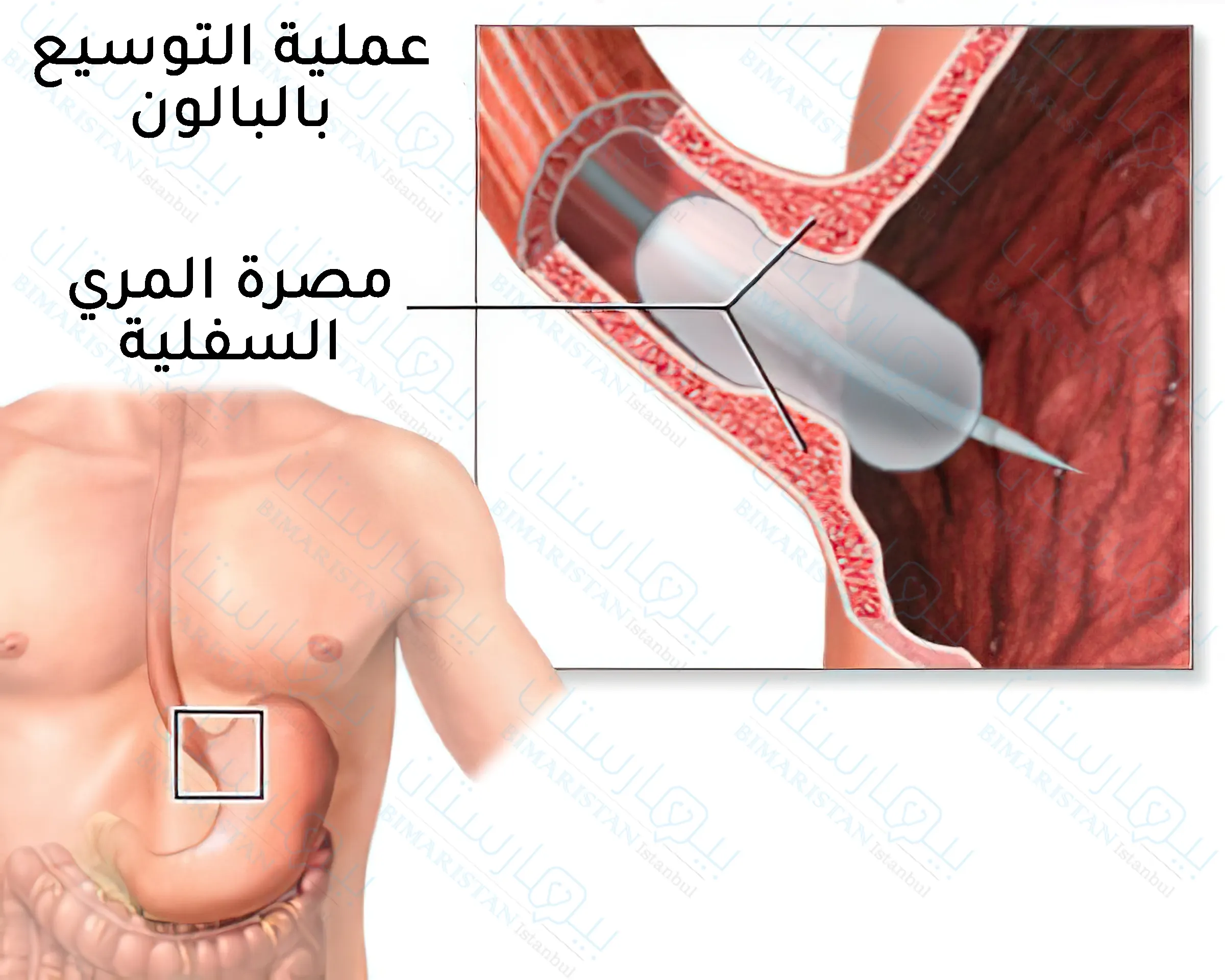 The esophageal sphincter dilatation surgery used to treat achalasia in Turkey