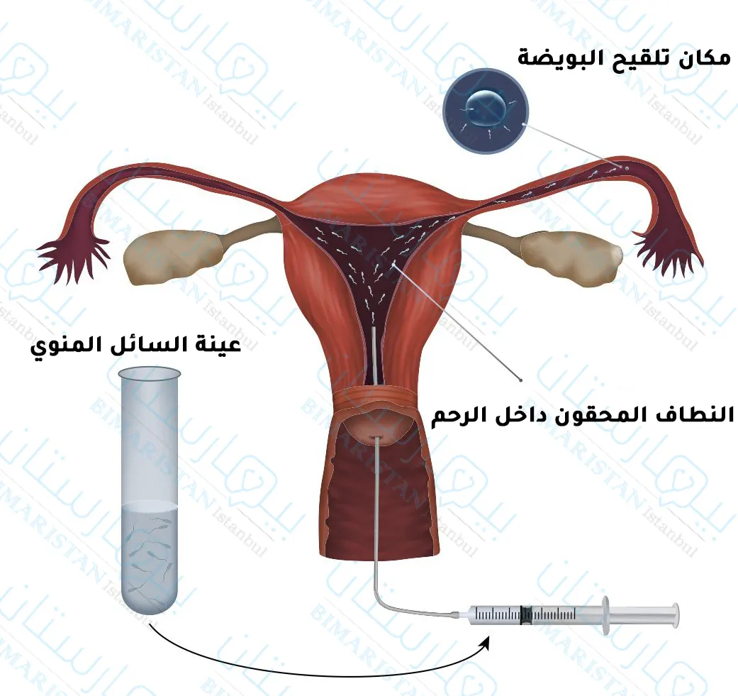 Intrauterine injection, which is one of the first options that infertile couples resort to
