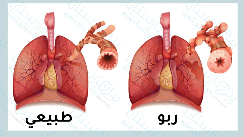 صورة تظهر تضيق القصبات عند مريض الربو بالمقارنة مع شخص طبيعي غير مصاب بالربو