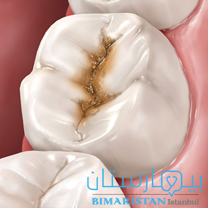 Tooth decay is one of the most common diseases