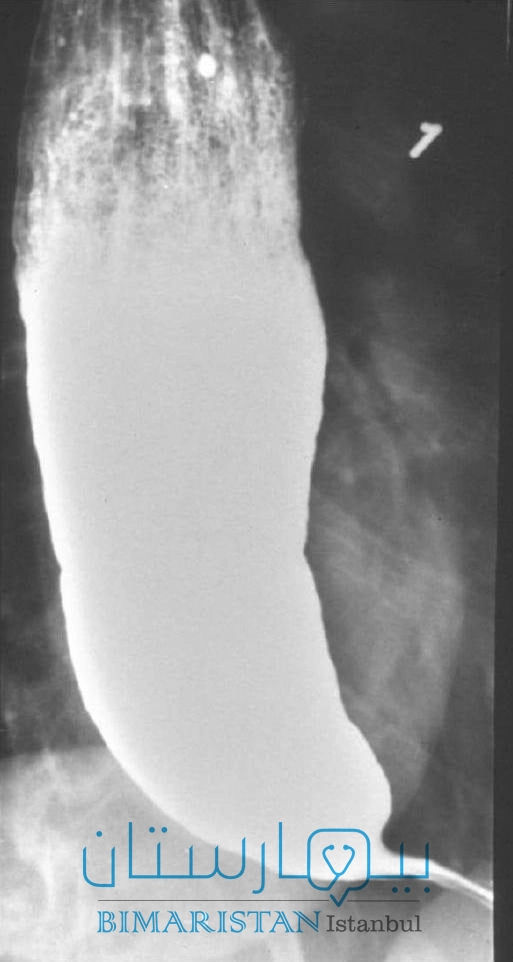 This is a radiograph of the esophagus with the radioactive barium swallowed, and we find in this image a large expansion of the esophagus with a narrowing of its lower end, which takes the form of a bird's beak, which is a distinctive appearance of the inability to relax the esophagus (Achalgia)