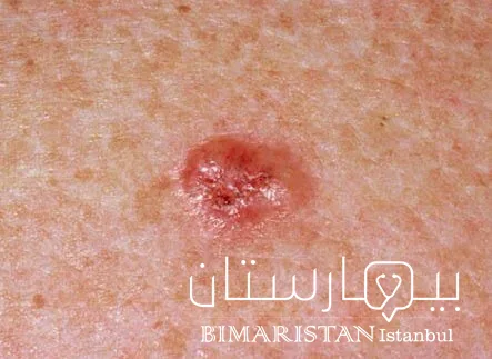 A suspicious skin lesion that, after biopsy, was found to be a basal cell type melanoma