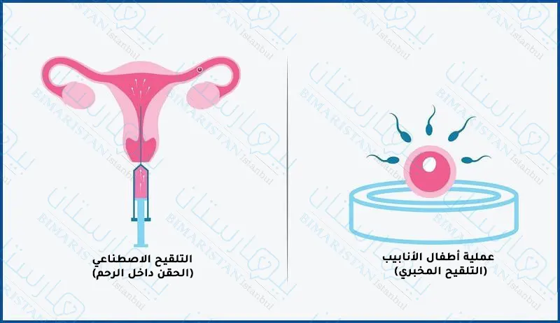 Türkiye'de intrauterin enjeksiyonlar ve IVF arasında basit bir karşılaştırma