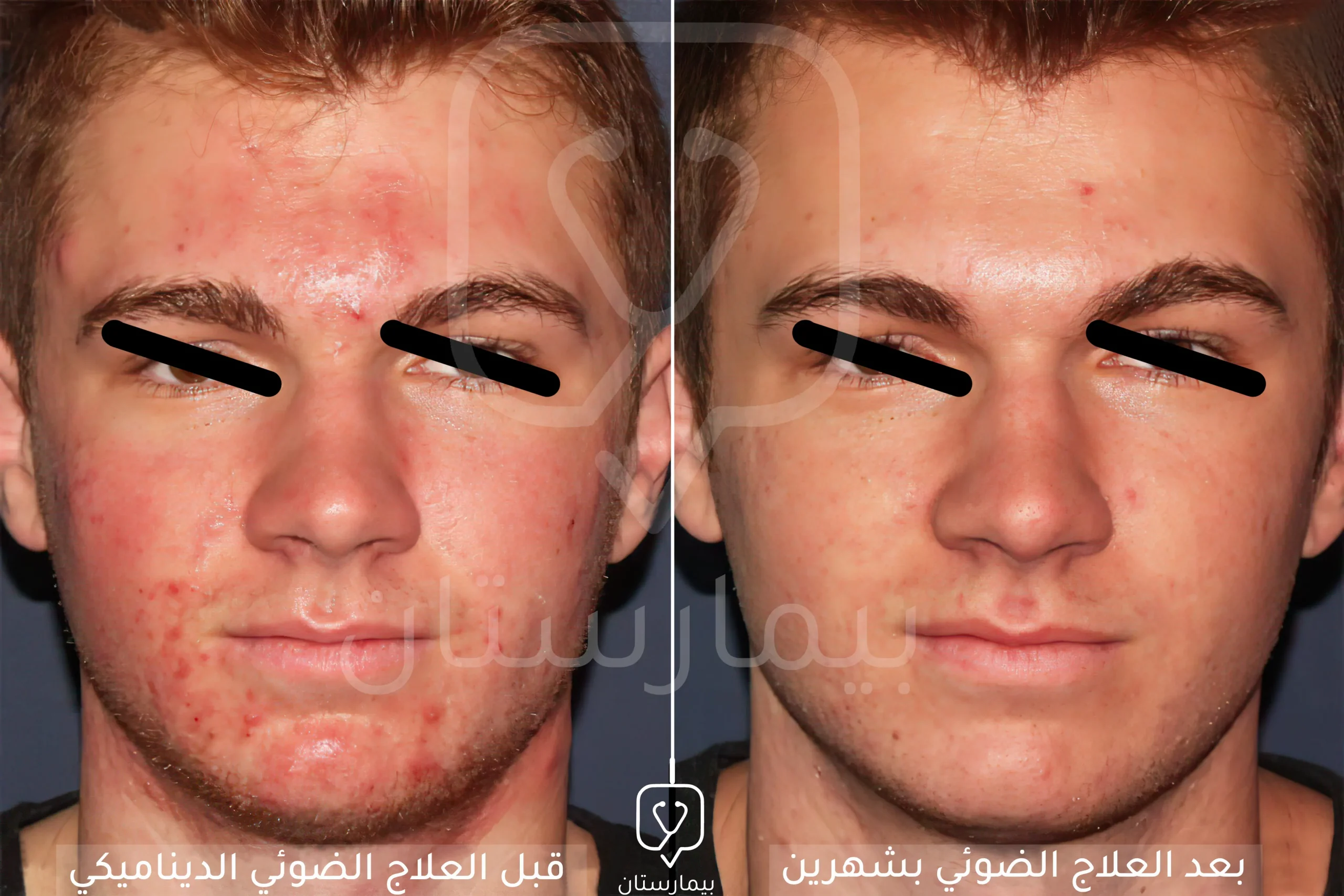تظهر هذه الصورة تأثير العلاج الضوئي الديناميكي وقدرته على إزالة الآفات الجلدية بشكل فعال