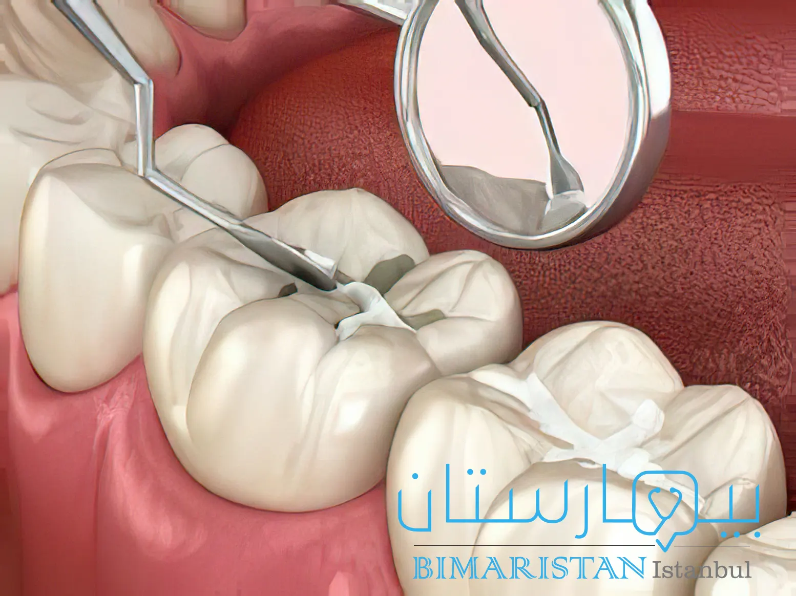 تطبيق المادة السادة ضمن ميازيب الأسنان للوقاية من النخور