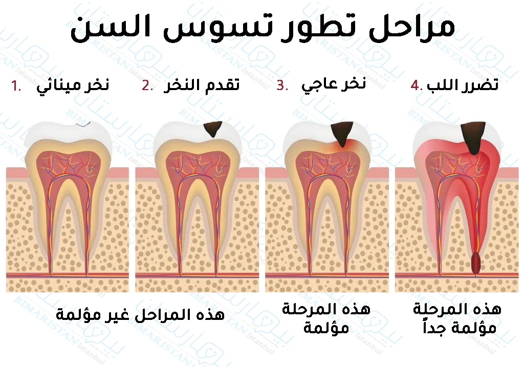 مراحل تطور تسوس الأسنان