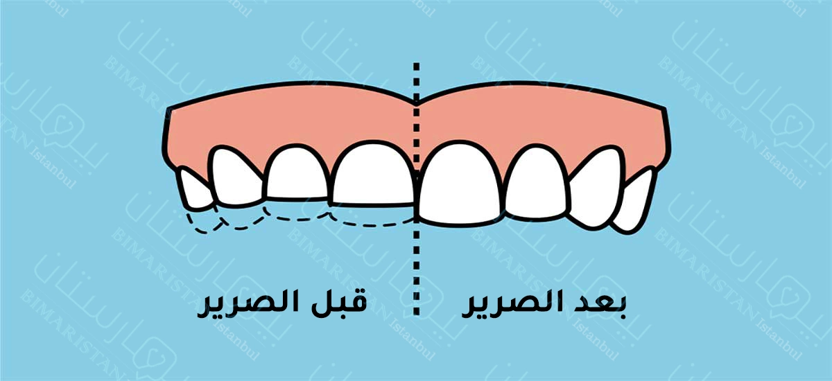 Diş gıcırdatma ve çekmeden önce ve sonra