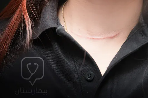 The scar remains insignificant after thyroidectomy at the base of the neck