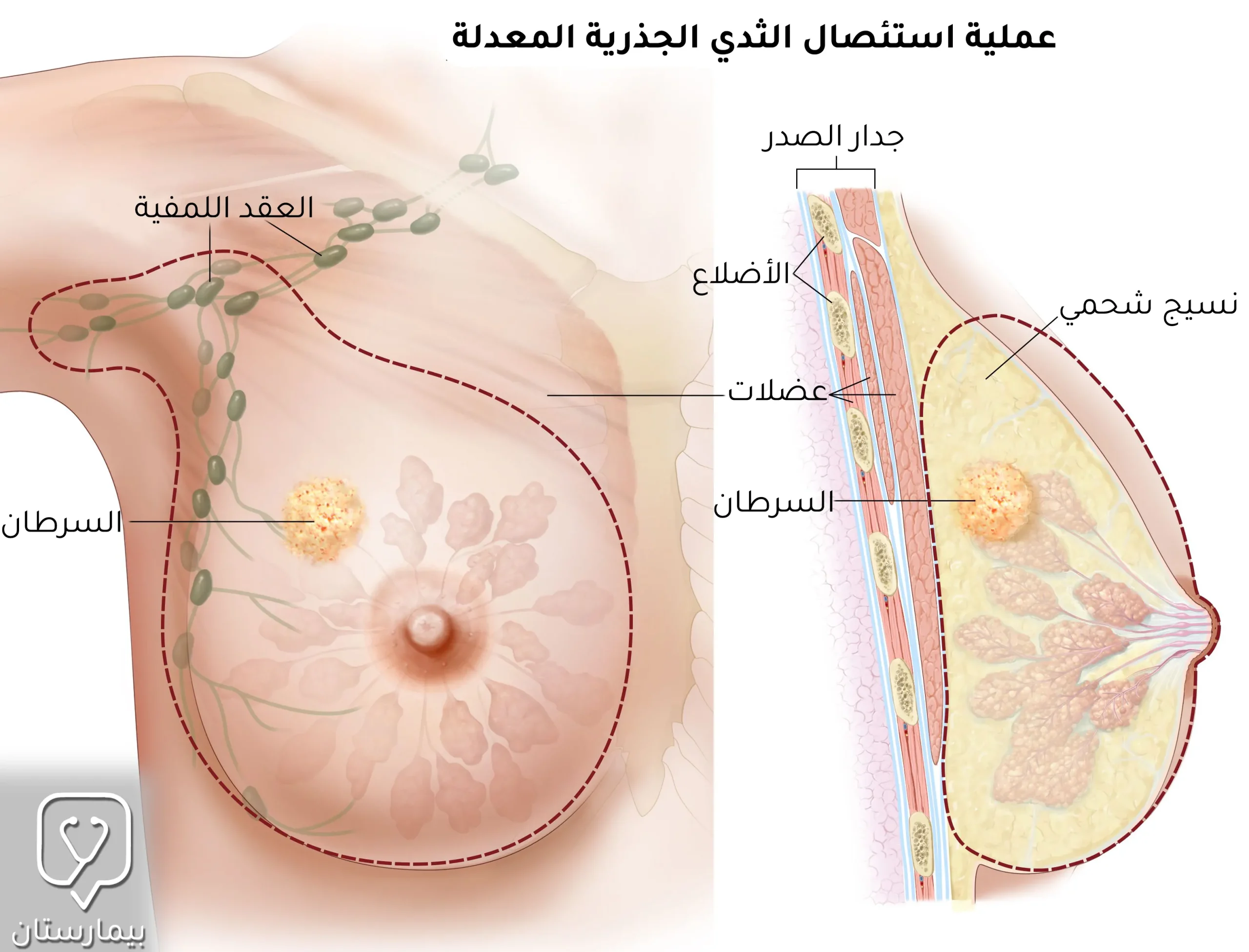 في عملية استئصال الثدي الجذرية المعدلة تتم إزالة كامل نسيج الثدي مع العقد البلغمية الإبطية