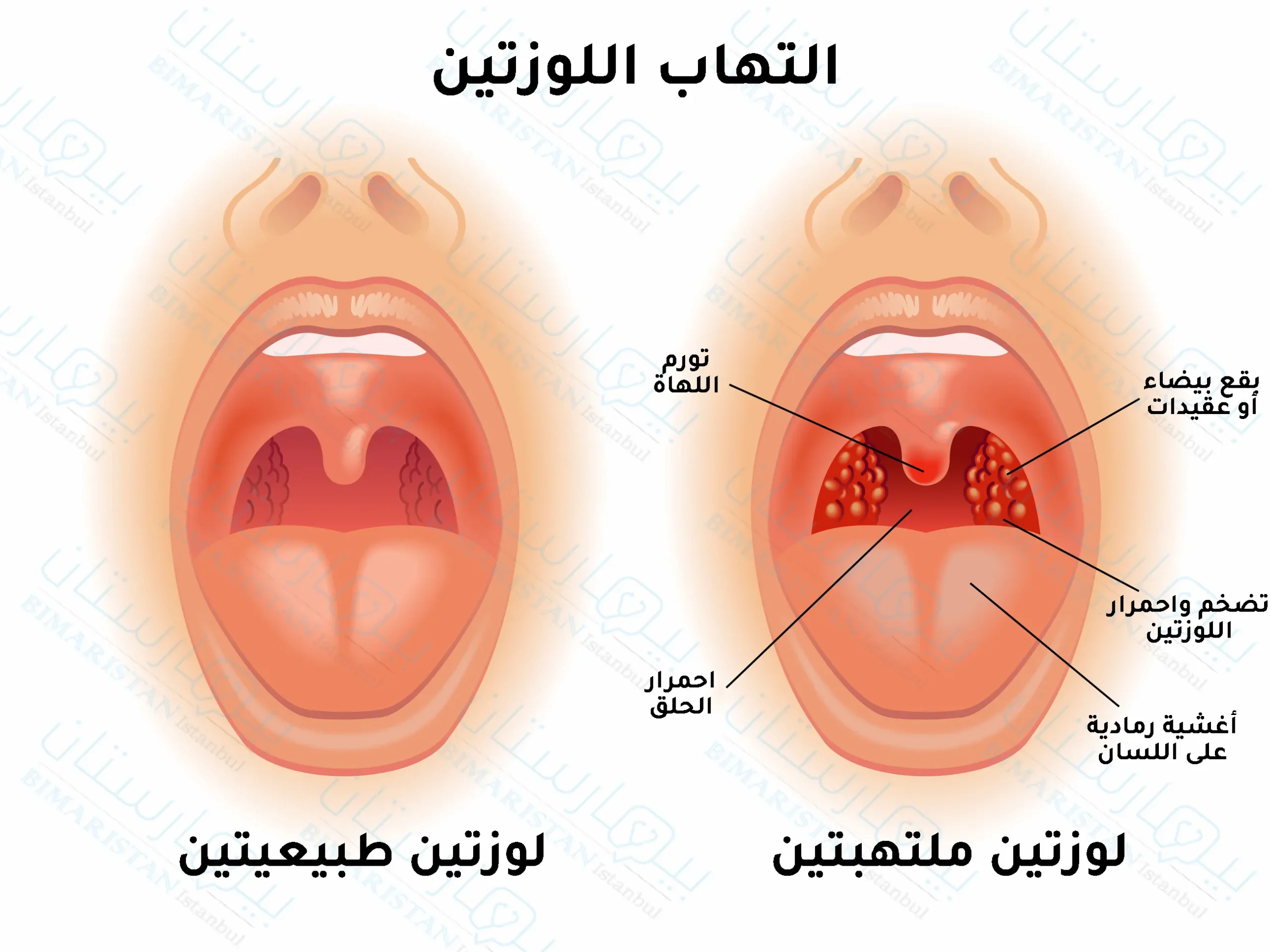 أعراض التهاب اللوزتين عند الأطفال وعلاجه في تركيا- بيمارستان