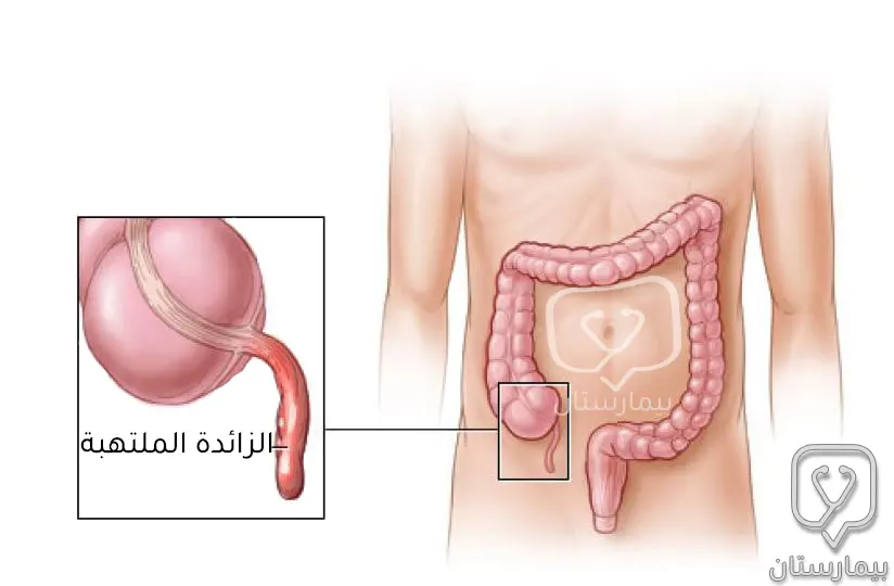 Anatomical position of the inflamed appendix