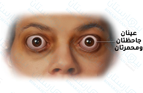 Hipertiroidili hastalarda gözler kırmızı ve çıkıntılı görünür