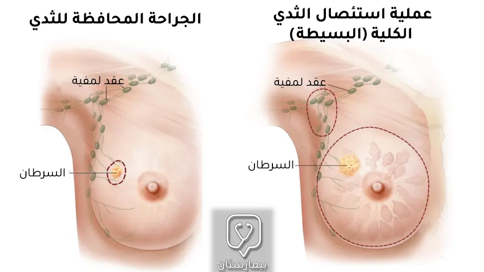 تتميز الجراحة المحافظة بالقدرة على استئصال الورم مع الحفاظ على نسيج الثدي والعقد البلغمية