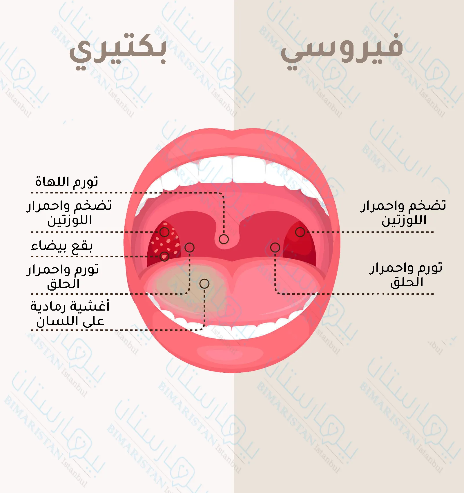 We note that bacterial tonsillitis is accompanied by more severe symptoms than viral tonsillitis, and it also has special characteristics such as white spots on the tonsils and white membranes on the tongue.