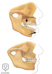 Treatment of open bite with orthognathic surgery in Turkey