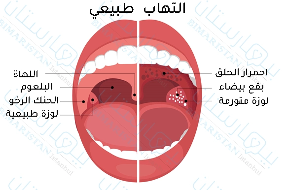 We notice swollen tonsils, white spots and redness of the throat when children have tonsillitis