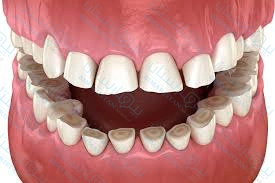 Dişlerin gıcırdatılması, sıkılması ve sertçe çekilmesi nedeniyle dişlerin boyunun kısalması