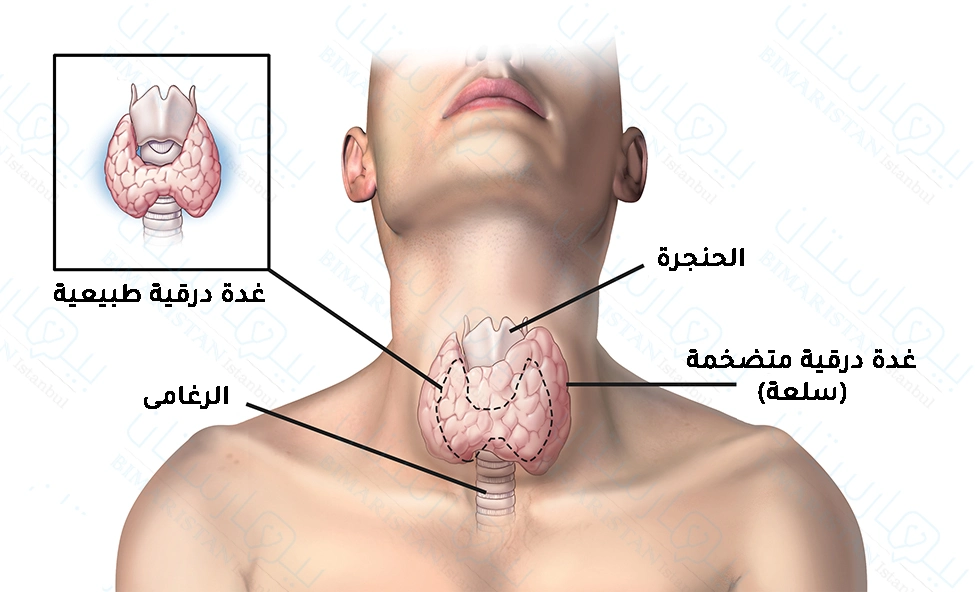 We notice an increase in the size of the thyroid gland than normal when hyperthyroidism occurs