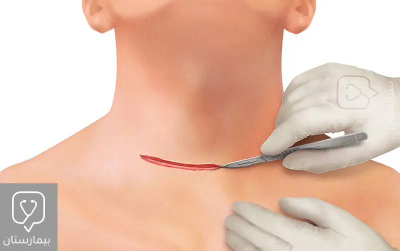 A small transverse incision is made in the crease of the skin at the base of the neck to perform the thyroidectomy