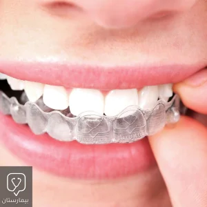 Deep bite treatment with transparent braces in Istanbul