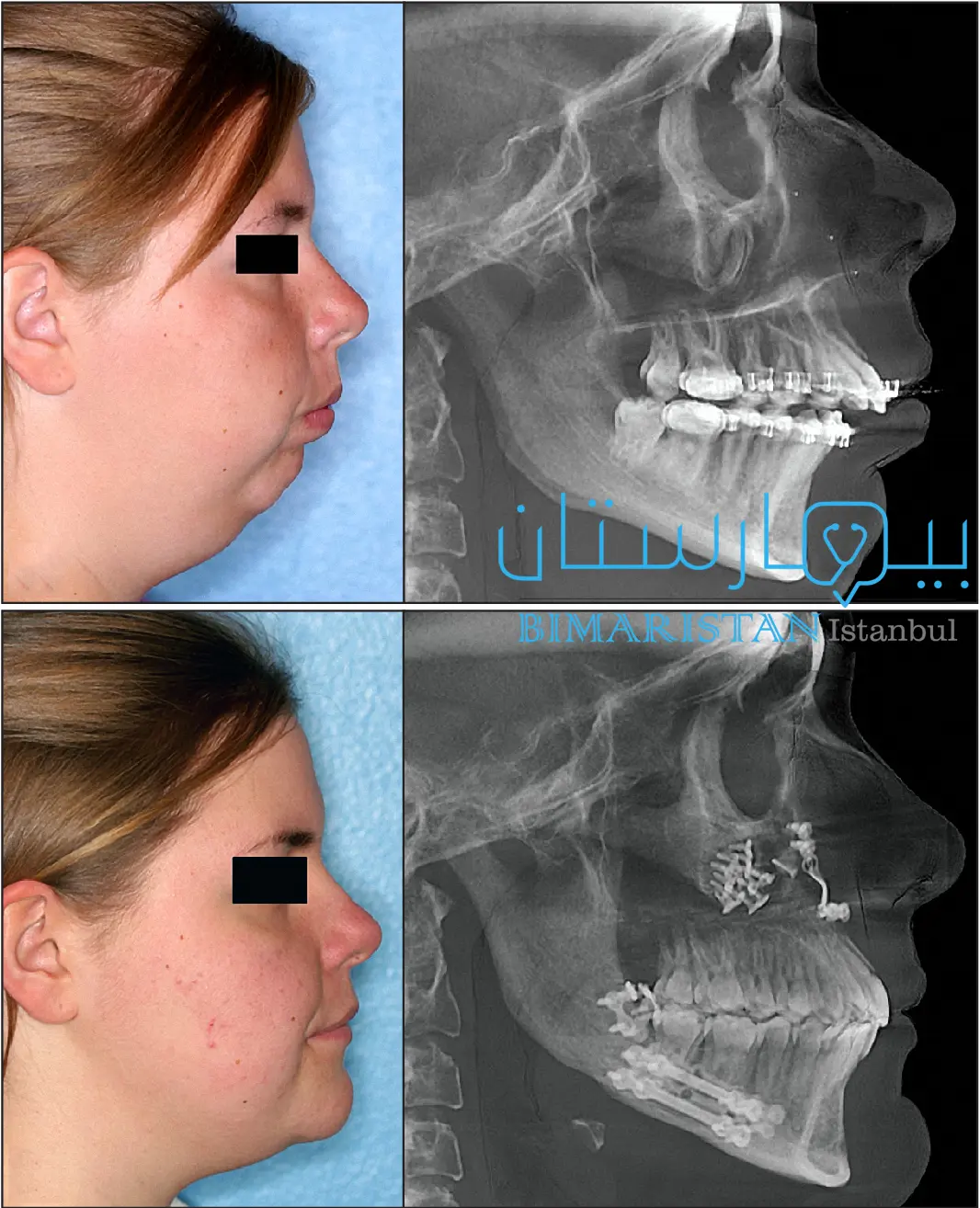 Before and after treatment of mandibular depression