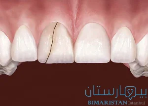 Broken tooth treatment in Istanbul