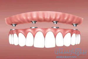 Full denture implants using the all in 4 technique in Istanbul
