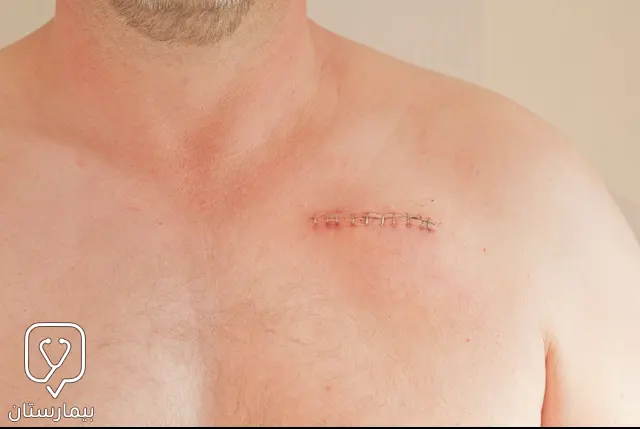 A small horizontal incision near the collar bone on the left side of the chest