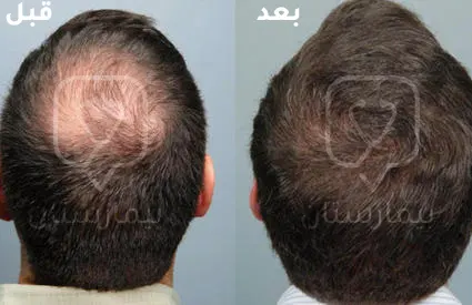 This image shows the experience of a person who underwent hair transplantation with stem cells, which is carried out within specialized centers in Turkey, and we note in the picture the emergence of the benefits of hair stem cells within a relatively short period of time