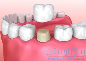 Dental crown dressing in one day in Turkey to treat a broken tooth