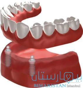 Ball Retained Implant-Supported Overdentures