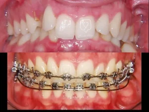 Orthodontic deep bite treatment in Turkey