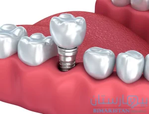 Dental implants in one day in Istanbul to replace a missing tooth