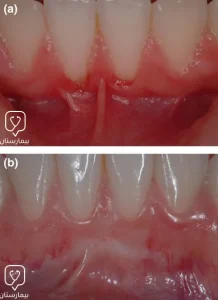 Gum implantation using free gum grafts in Turkey