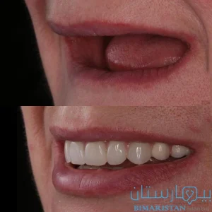 Implanting a full denture for a patient suffering from the loss of all teeth