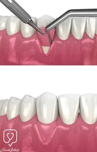Gum transplantation using connective tissue grafts in Istanbul