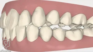 علاج العضة المفتوحة للأسنان الخلفية في تركيا