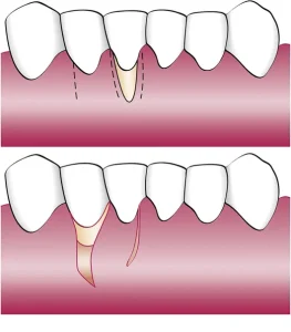 Gum surgery with a side-shifted flap technique to cover the exposed root 