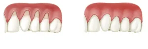 Covering the place of gum recession using gum grafts in Istanbul