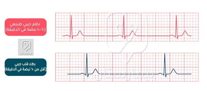 نلاحظ تطاول المسافة R-R في التخطيط الكهربائي في حالة بطء نبضات القلب