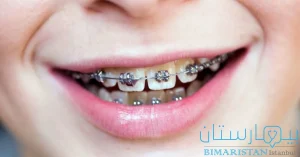 Dental Crowding Treatment in Istanbul with Orthodontics
