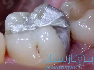 Dental amalgam filling is easy to apply