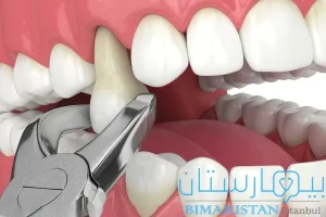 You may have to extract some teeth during crowding treatment