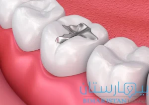 Silver-coloured dental amalgam filling